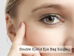雙眼皮眼袋手術案例分享