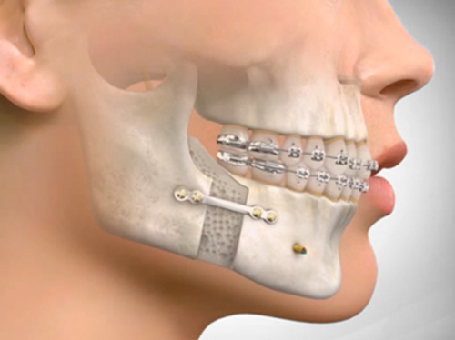 正顎齒顎矯正介紹，怎麼樣才算是成功的正顎齒顎矯正手術