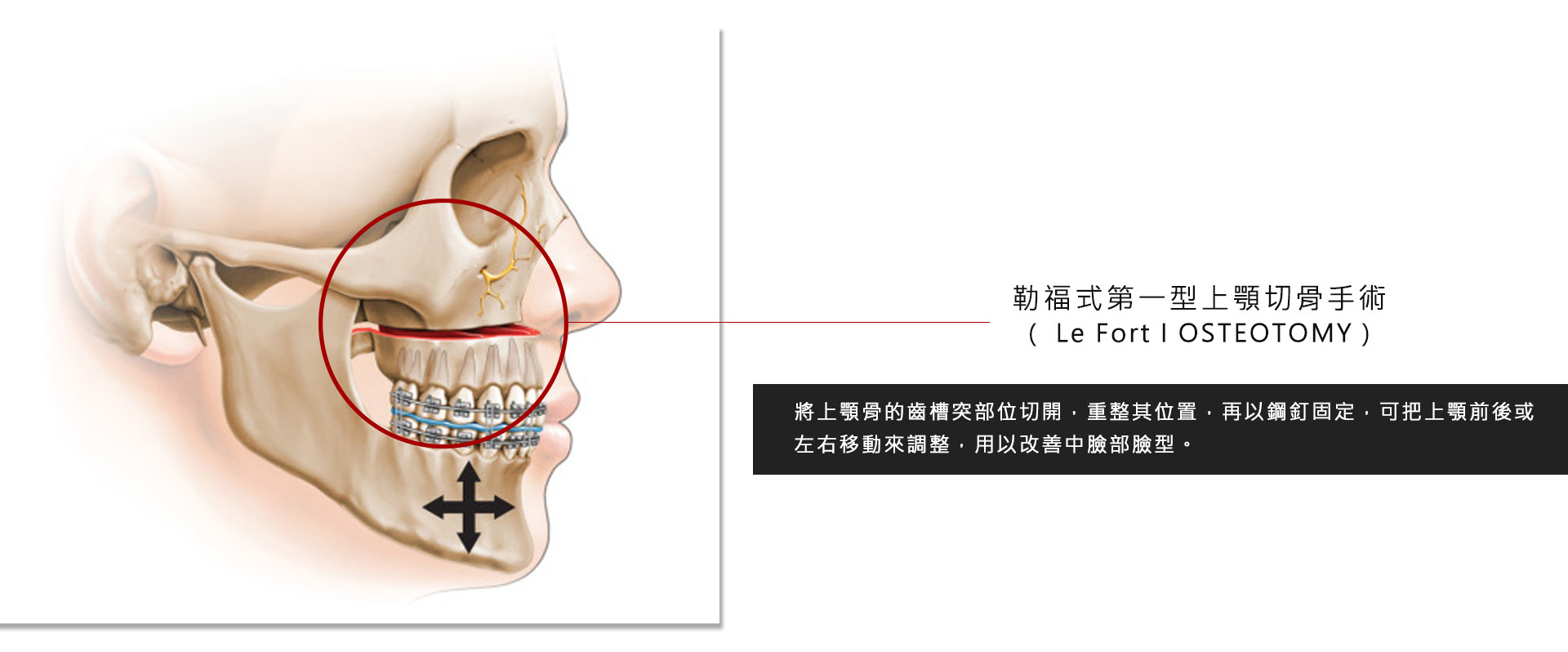 正顎齒顎矯正介紹 怎麼樣才算是成功的正顎齒顎矯正手術 正顎齒顎矯正手術 Motiva魔滴隆乳 Vaser威塑水刀抽脂 隆鼻下巴整形台北亞緻taipei Arts權威醫師推