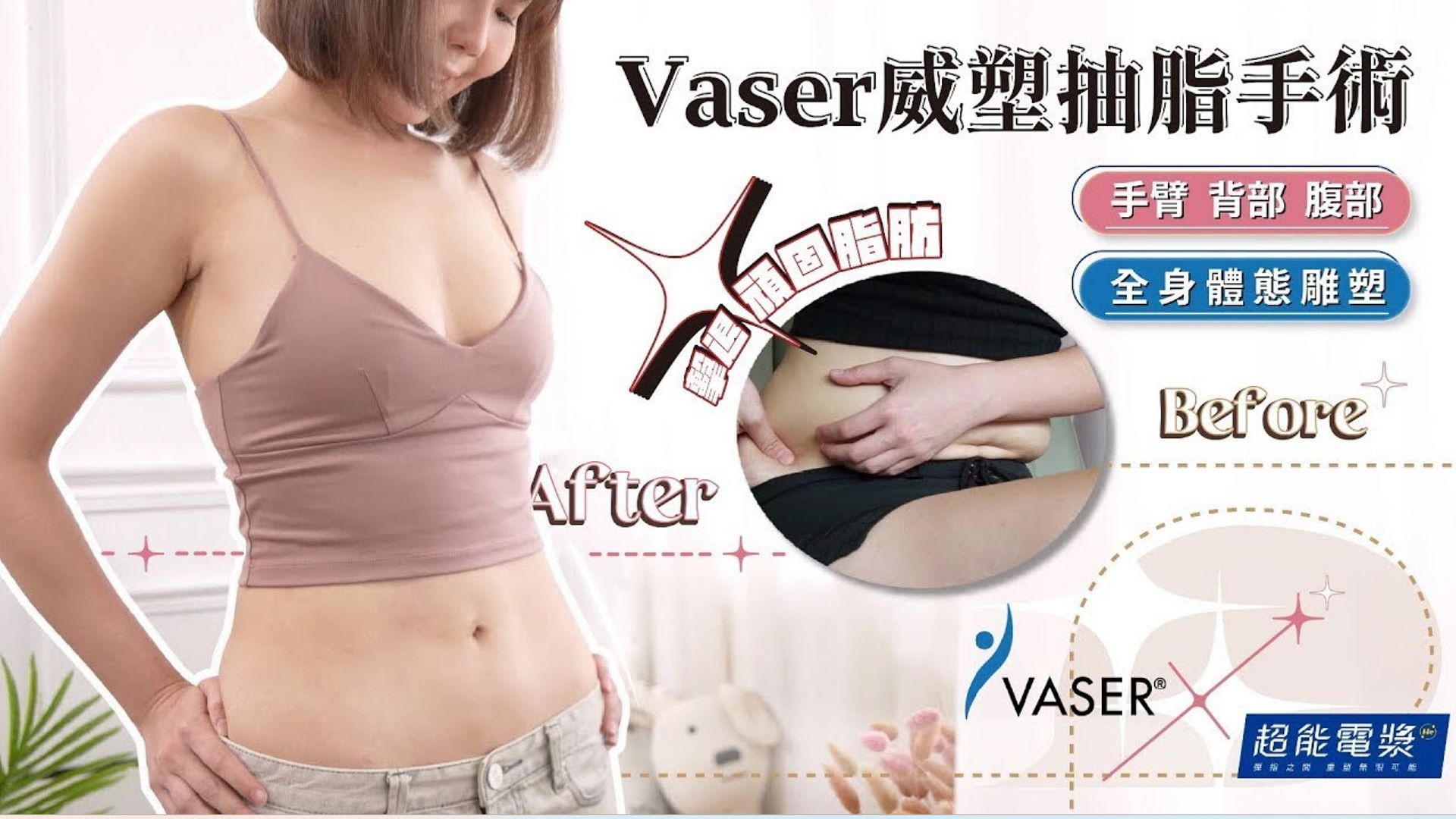 Vaser2.2威塑抽脂手術手臂、背部、肚子&超能電漿緊實全身體態雕塑，ViVi的曼妙體態後天成形術 台北抽脂 亞緻整形TaipeiArts